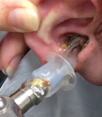 Cách xử lý an toàn khi bị côn trùng bò vào tai